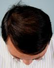 After Hair Transplant&nbsp;Front